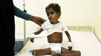 Une enfant mal-nourrie hospitalisée au Yemen, le 5 novembre 2017 [ABDO HYDER / AFP/Archives]