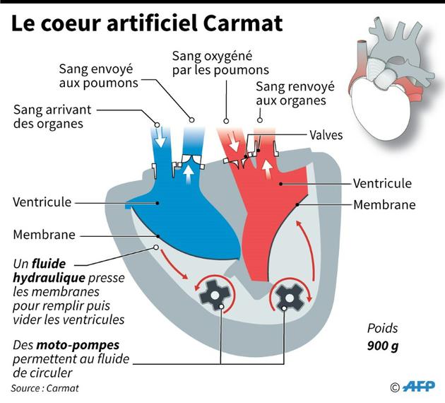 Le coeur artificiel Carmat [Sophie RAMIS / AFP]