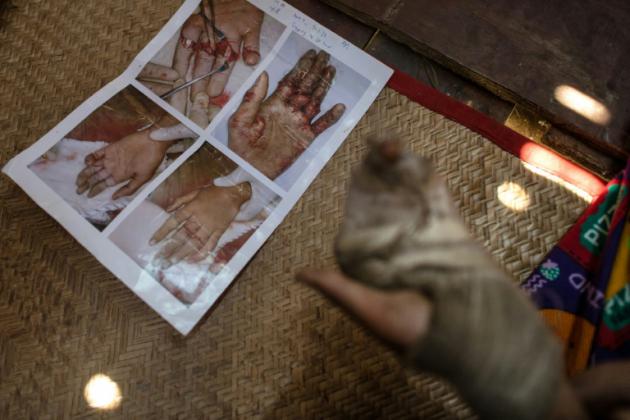 Deux des doigts de San Min Hteik ont été sectionnés au niveau de l'os [Ye Aung Thu / AFP/Archives]